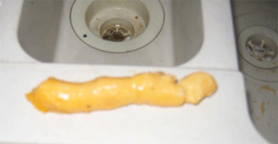 fat blockage found in a washing machine drain